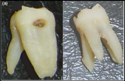 Gambar 8. Gigi  molar  satu  mandibula      dengan supernumerari akar24 