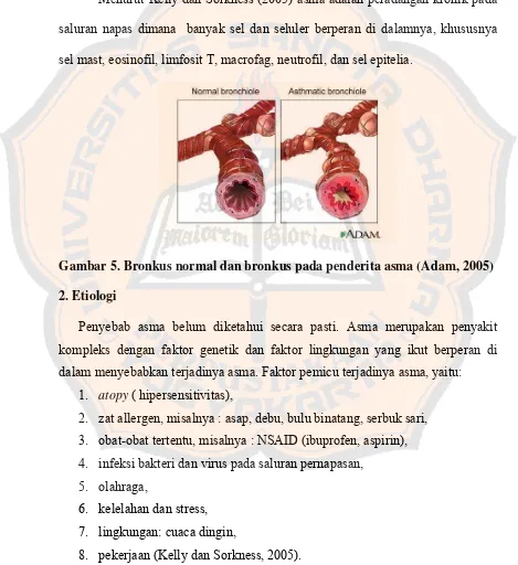 Gambar 5. Bronkus normal dan bronkus pada penderita asma (Adam, 2005) 