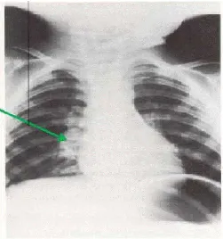 Gambar 2.7 Gambaran pembesaran hilus kanan pada TB primer