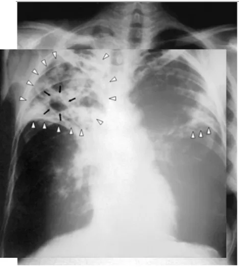 Gambar 2.9 Gambaran kavitas pada TB paru