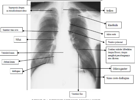 Gambar 2.4 Gambaran radiologi thorax normal
