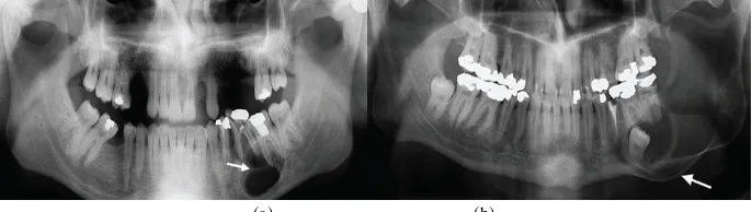 Figure 1. The cyst and tumor lesion on dental panoramic images. (a) cyst lesion (arrow), (b) tumor lesion (arrow) 
