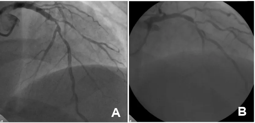 Gambar 1A. Lesi koroner di daerah left anterior descending artery (LAD) pada Tn Fa.Gambar 1B