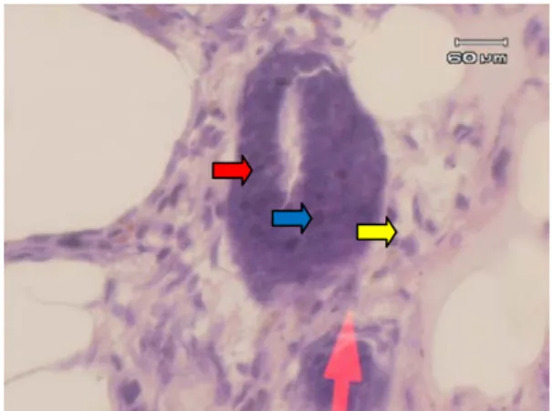 Gambar 2.  Gambaran mikroskopik payudara  mencit  kelompok B (perlakuan 1) yang diinduksi  benzo(a)pyrene