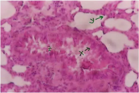Gambar 3. Gambaran mikroskopis paru yang terkena kanker (perbesaran 100 X)