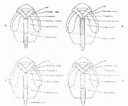 Gambar I . Klasifikasi celah bibir dan langitan menurut Veau's A. Klas I hanya mengenai  palatum lunak , B klas II Meiigenai palatum lunak dan keras tapi tidak termasuk procesus  alveolar, C klas III Unilateral dari celah bibir dan langitan dan D