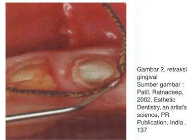 Gambar 2. retraksi gingival Sumber gambar : Patil, Ratnadeep, 2002. Esthetic Dentistry, an artist’s science, PR Publication, India , 137