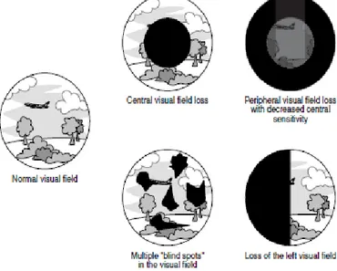 Gambar 1. Contoh Wilayah Pandangan Terbatas (Klein, 2000)