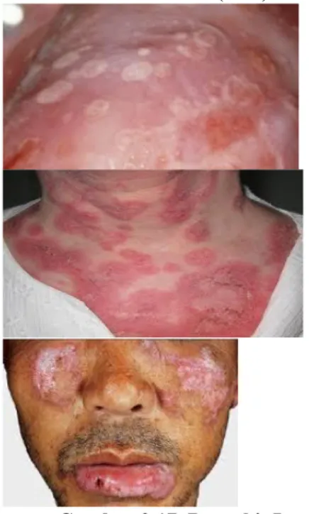 Gambar 2.17  Penyakit Lupus 