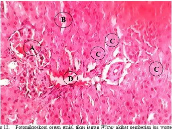 Gambar 12.Fotomikroskopi organ ginjal tikus jantan Wistar akibat pemberian jus wortel dosis 1,094 g/kgBB yang mengalami nekrosis tubulus fokal (pengecatan hematoksilin-eosin pembedahan 24 jam dengan perbesaran 400x).Keterangan : A
