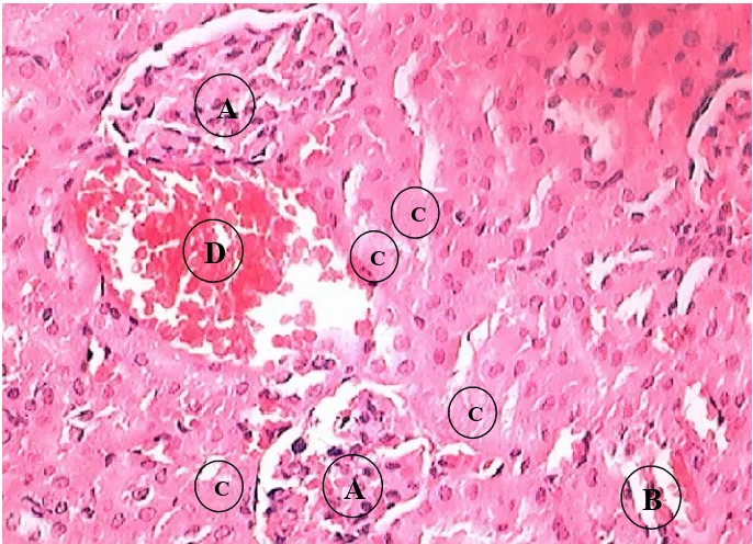 Gambar 13.Fotomikroskopi organ ginjal tikus jantan Wistar akibat pemberian jus wortel dosis 2,188 g/kgBByang mengalami nekrosis tubulus fokal menuju multifokal (pengecatan hematoksilin-eosin pembedahan 24 jam dengan perbesaran 400x).Keterangan : A