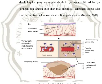 Gambar 2.1 Patofisiologi Luka Kanker 