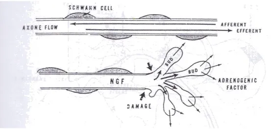 Gambar 5. Proses Pembentukan Neuroma (Diambil dari kepustakaan no. 26) 