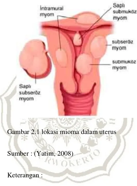 Gambar 2.1 lokasi mioma dalam uterus 
