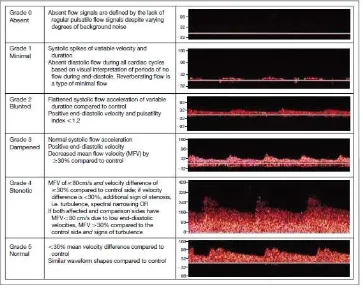 Gambar  6  : Contoh tingkatan aliran TIBI dengan kedalaman yang berbeda pada oklusi arteri serebri media akut 