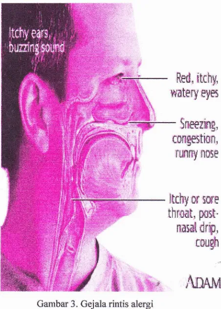 Gambar 3. n Gejala rintis alergi