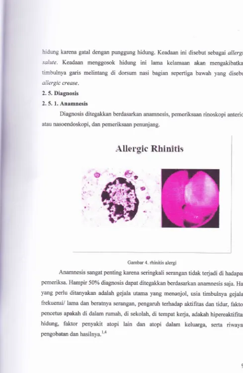 Gambar 4. rhinitis alergi