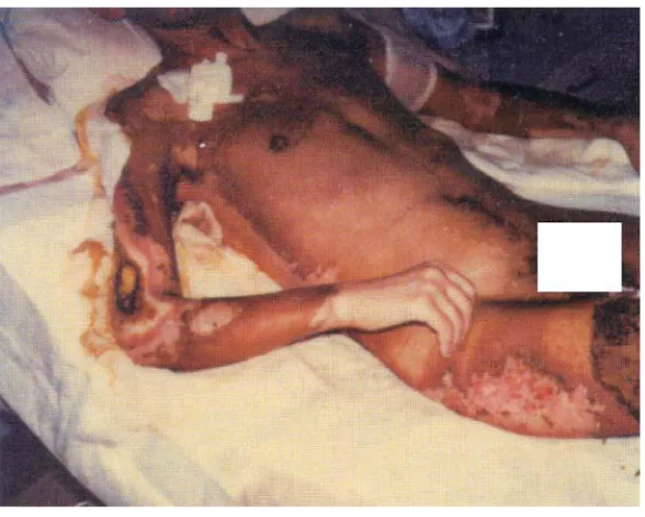 Gambar 2. Kasus SRA yang disertai dengan  sindroma kutaneus pada korban Chernobyl.  