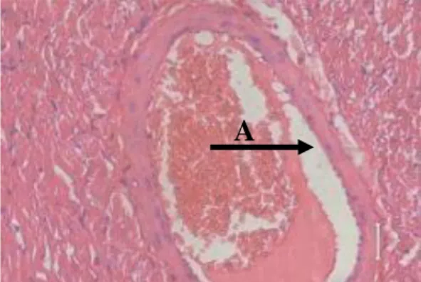 Gambar  2.Gambaran  mikroskopis  histologist  arteri  koronaria  tikus  putih,  kelompok  kontrol  positif  yang  diberi  pakan  hiperkolesterolemik