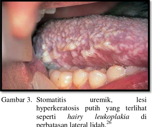Gambar 4. Stomatitis uremik, pseudomembran keputihan abu-abu pada  lidah dan dasar mulut.26 