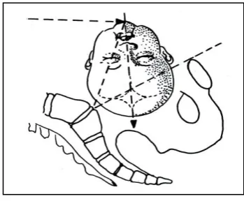 Gambar C = Asynclitismus Posterior 