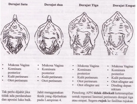 Gambar Robekan perineum 