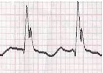 Gambar 2.4 Contoh analisa dari kertas EKG