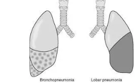 Gambar 1. Bercak pada paru (Bronchopneumonia) 