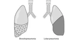 Gambar 1. Bercak pada paru (Bronchopneumonia) 