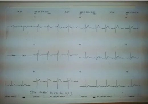 Gambar 5. EKG 27.03.2014 (lead prekordial dipasang lebih superior 1 sela iga)