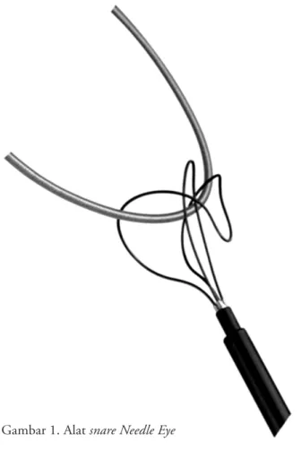 Gambar 1. Alat snare Needle Eye