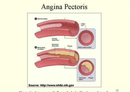 Gambar 4. 1: Kondisi arteri pada angina pectoris  c)  Aritmia 