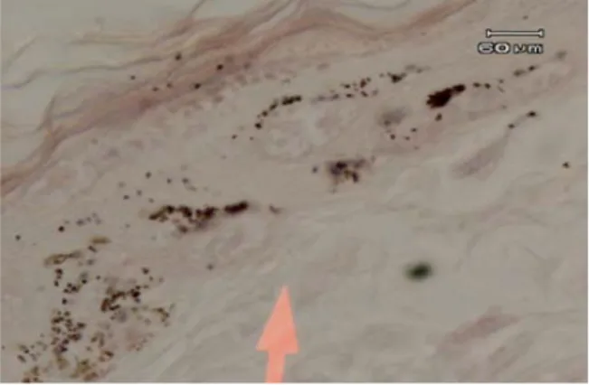 Gambar 2. Tampak butir-butir pigmen  melanin warna coklat kehitaman terdapat pada  lapisan epidermis juga pada lapisan keratin  (panah merah).