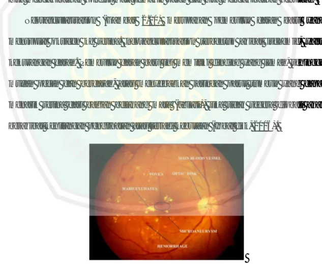 Gambar 2.4 Variasi fitur retinopati (Ravishankar, 2009)