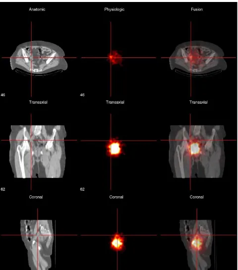 Fig. 1 – SPECT and subsequent CT scan were performed in one session and both investigations were combined to produce afused image for further interpretation