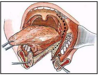 Gambar 1. Lip-Split Mandibulotomi (Booth PW, Schendel SA, 