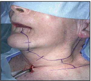 Gambar 2. Penandaan pada kulit untuk dilakukan insisi. (Fernandes R, Ord R. Access surgery for oral cancer