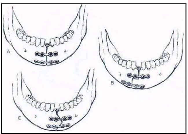 Gambar 4. Pemasangan Miniplate Setelah dilakukannya Mandibulotomi.( Donald PJ. Surgery of the skull base.Philadelphia : Lippincott-Raven Publisher, 1998 : 344) 