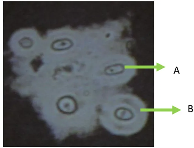 Gambar 7. Pewarnaan tinta india: sel ragi berkapsul,  C. neoformans dari  spesimen  cairan  otak  pasien  AIDS