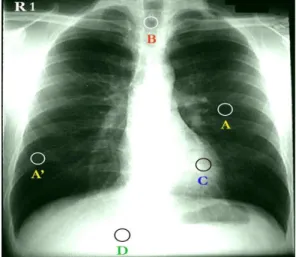 Gambar 4.1   Cara pengukuran densitas thorax  Keterangan : 