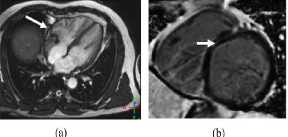 Gambar 4. sequence CINE 4CH REST dan sequence Late Gadolinium  Enhancement (LGE) 