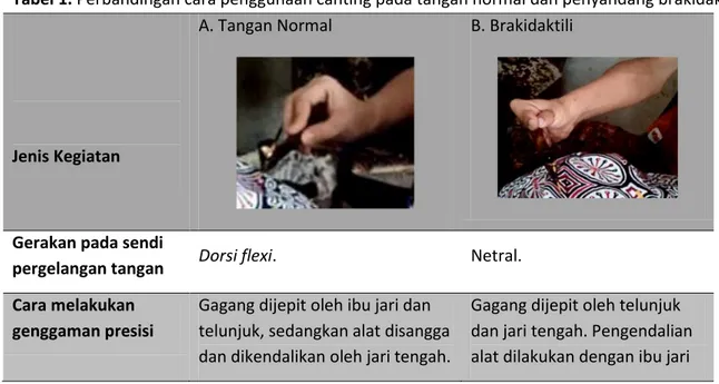 Tabel 1. Perbandingan cara penggunaan canting pada tangan normal dan penyandang brakidaktili