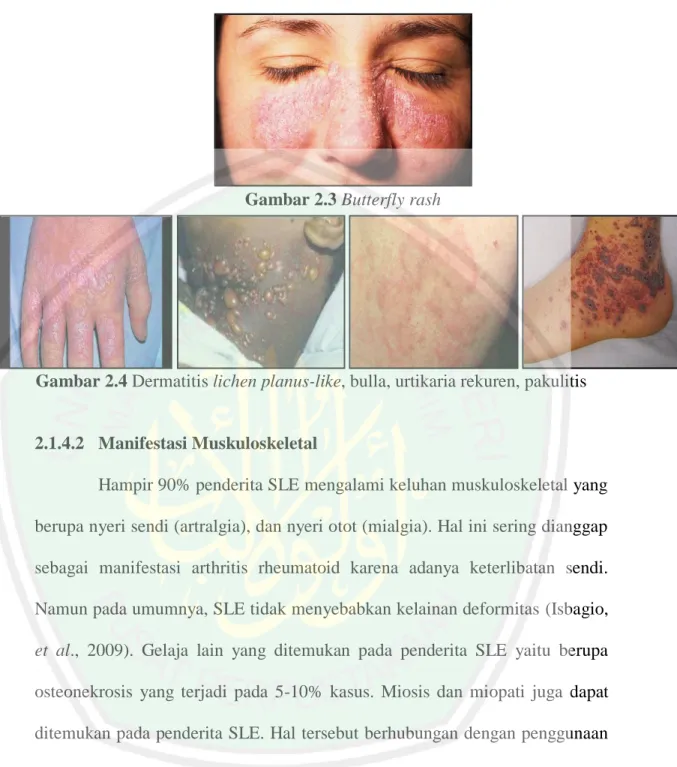 Gambar 2.3 Butterfly rash 
