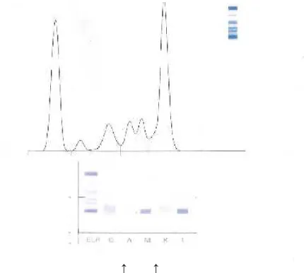 Gambar 4. Hasil Pemeriksaan Immunofiksasi Protein Dengan kesan ditemukan monoklonal IgM Lambda