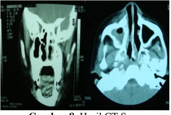 Gambar 8. Hasil CT Scan 
