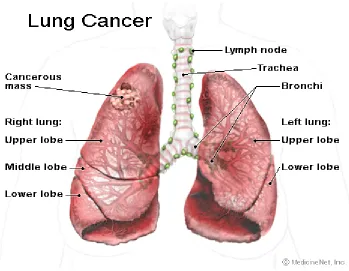 Gambar 1. Kanker Paru-paru (Joshi, 2008). 
