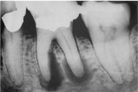 Gambar 2.1. Gambaran radiografi periodontitis apikalis kronis. 