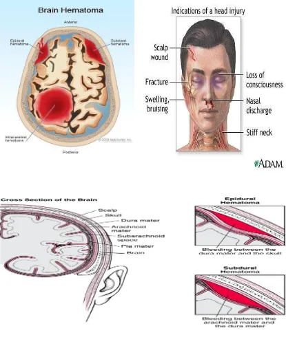Gambar 2.2.2. Anatomi Trauma kapitis berdasarkan Lokasi Anatomik 