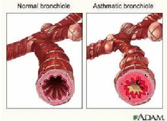 Gambar 1. Bronkus normal dan bronkus pada penderita asma (Adam, 2005)