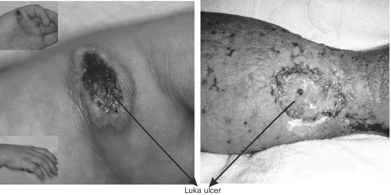 Gambar 4. Luka ulcer yang disebabkan oleh C.ulcerans ( Gambar A: Sumber: Rare human skin infection with Corynebacterium ulcerans: transmission by a domestic cat, MAM Corti,  Gambar B: Sumber:  C